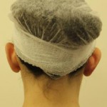 Отопластика: как ускорить восстановительный период после процедуры