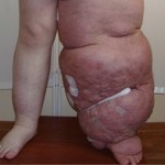 Способы лечения лимфостаз в клинике флебологии