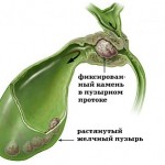 Жизнь после удаления желчного пузыря: возобновление привычного образа жизни